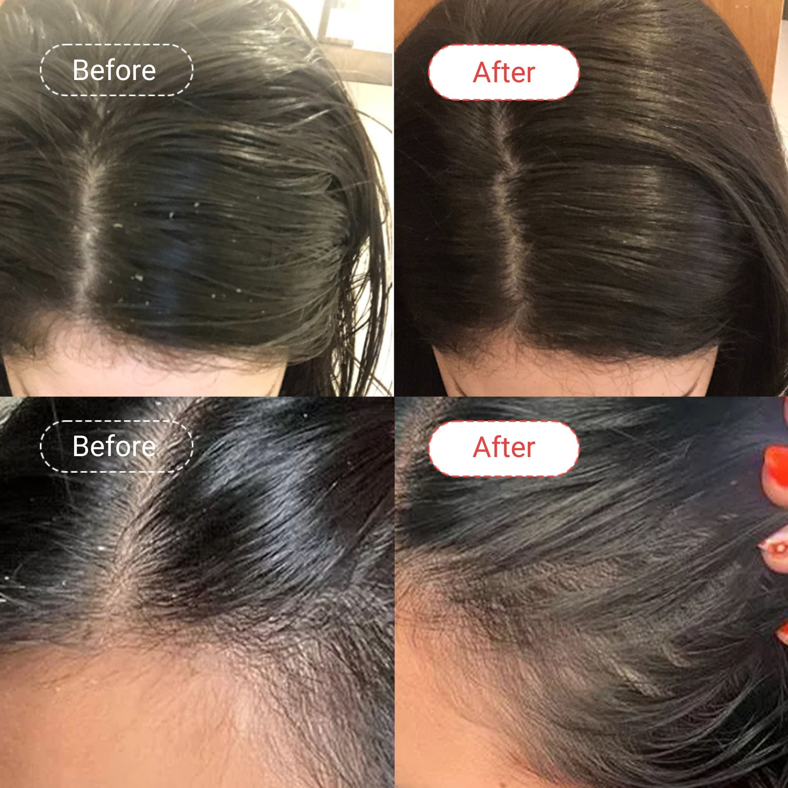 AccuFix - Anti-Dandruff Salicylic Acid Shampoo